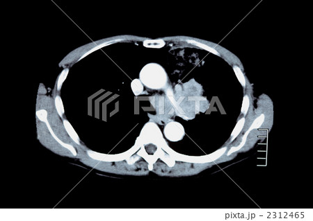 胸部 Ct 検査 肺の写真素材