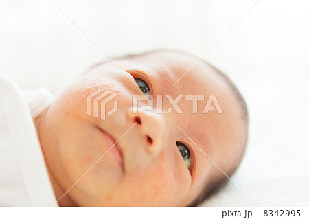 新生児黄疸の写真素材