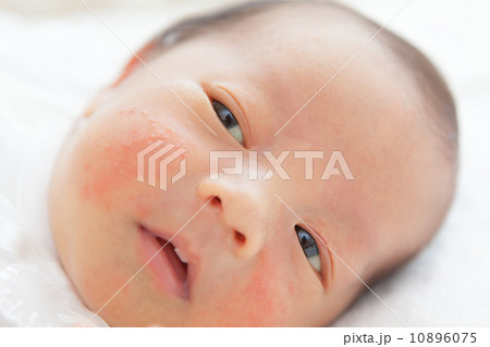 新生児ニキビの写真素材