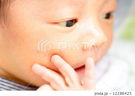 黄疸の写真素材