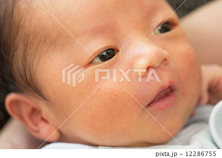 新生児黄疸の写真素材