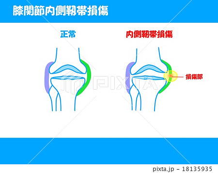 膝関節内側靭帯損傷のイラスト素材