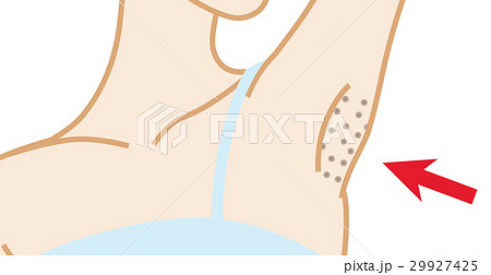 女性 脇 脇の下 黒ずみのイラスト素材