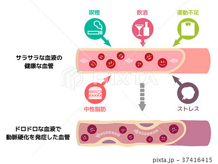 動脈硬化のイラスト素材