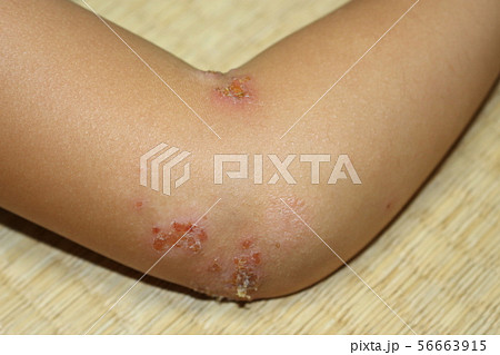 子供の湿疹 の写真素材