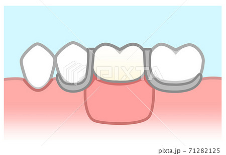 義歯のイラスト素材
