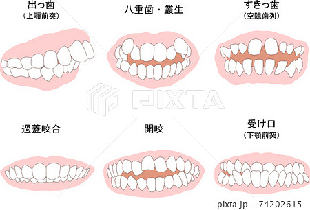 しゃくれのイラスト素材