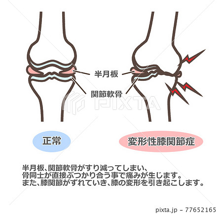 半月板のイラスト素材