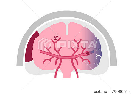 脳出血のイラスト素材