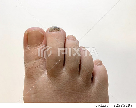 内出血 爪 足 足指の写真素材